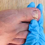 How Safe Is Nail Removal Surgery for Your Toenails