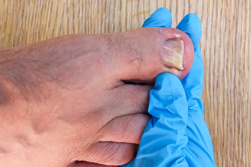 How Safe Is Nail Removal Surgery for Your Toenails
